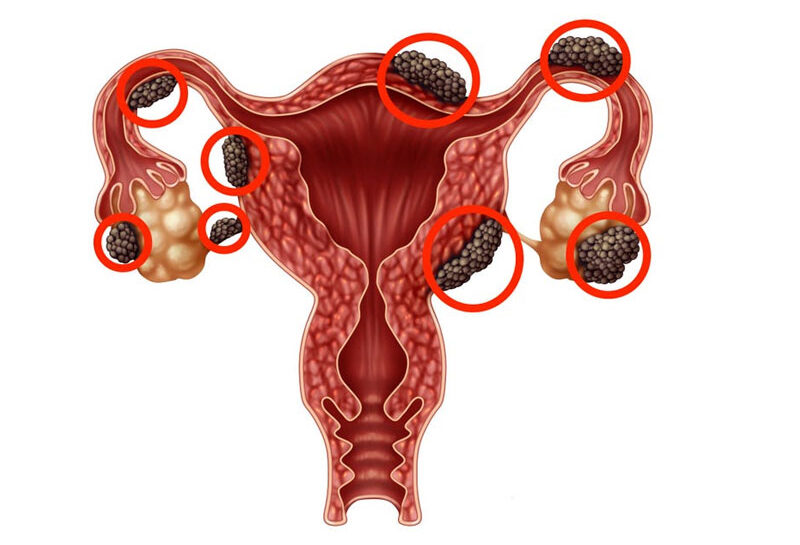 endometriozis endometriozis